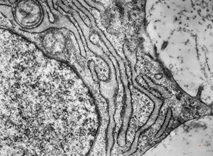 M,19y. | chondrocyte - chondrosarcoma - jaw